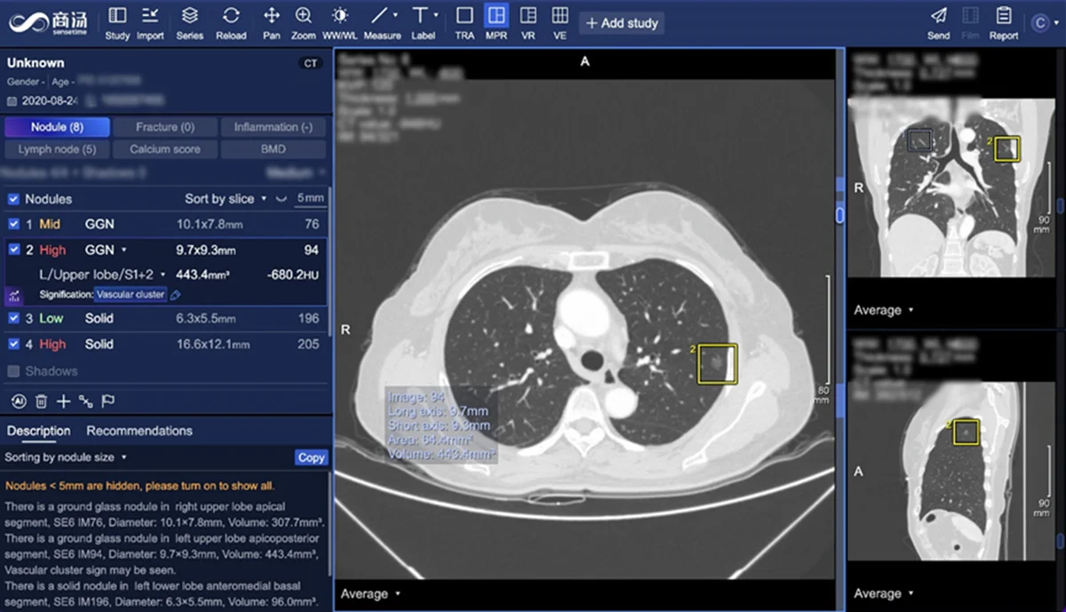 商湯SenseCare®系統於新加坡IHH醫療集團旗下百匯放射科正式上線